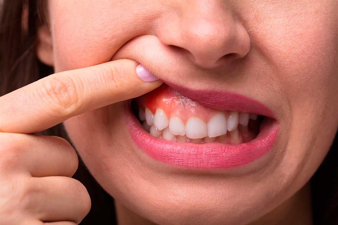 أسباب التهاب اللثة وطرق العلاج
