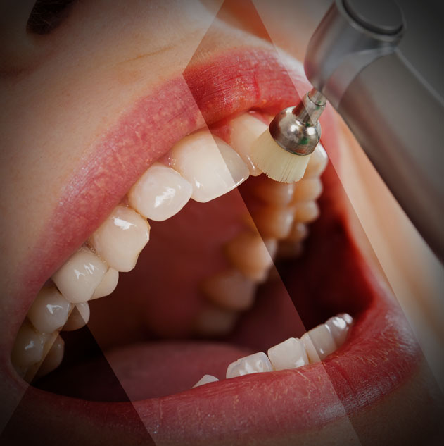 تبييض الاسنان 